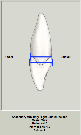Mx Lateral Crown Width Prox.png